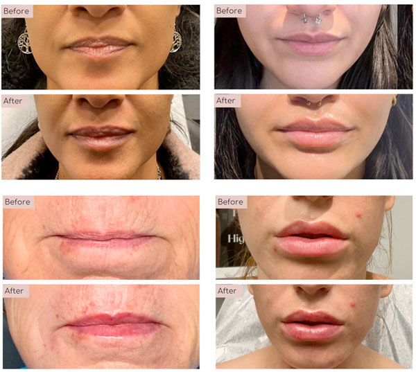 lip fillers before and afters